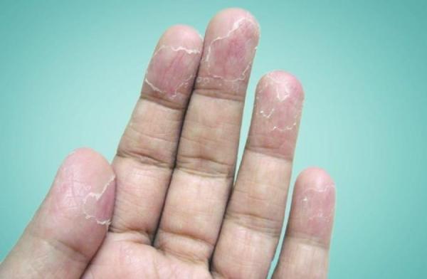علل و راههای درمان پوسته شدن انگشتان دست