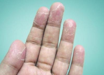 علل و راههای درمان پوسته شدن انگشتان دست