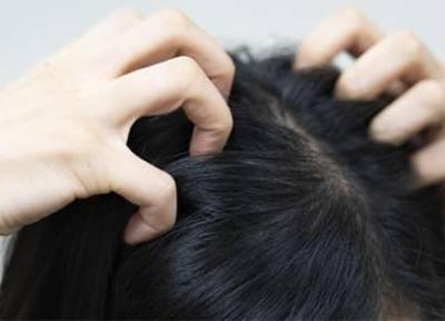 با 8 روش موثر و ساده خانگی، خشکی پوست سر را درمان کنید!